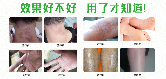 草莓视频苹果下载真菌清喷剂 草莓视频苹果下载真菌清喷剂